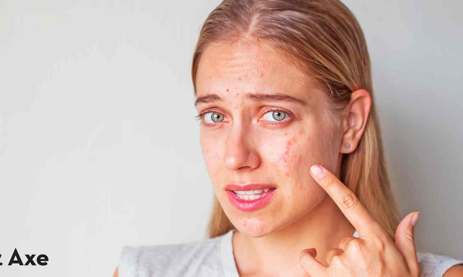 How to Get Rid of Nodular Acne